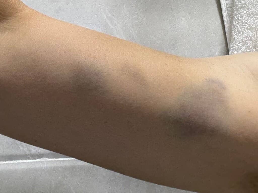 Rejuvenating Skin Peels